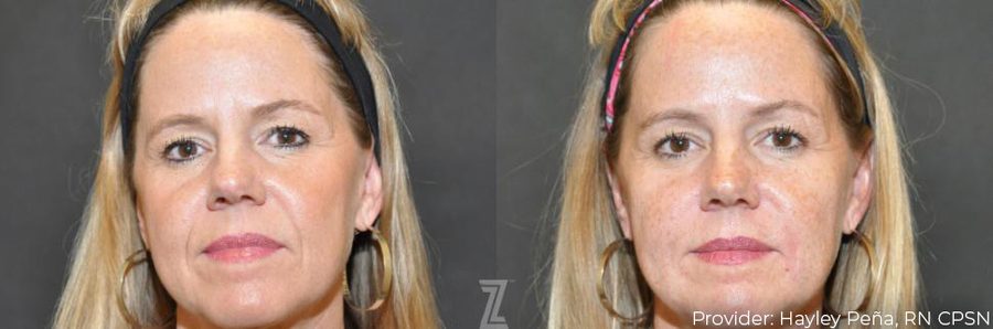 The Age-Defying Benefits of Full Facial Balancing | Piazza Center for Plastic Surgery and Advanced Skin Care