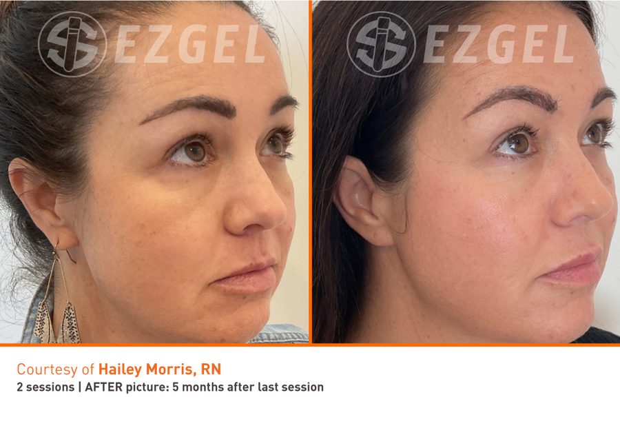 ezGEL Under eye Before and After under eye results with ezGEL