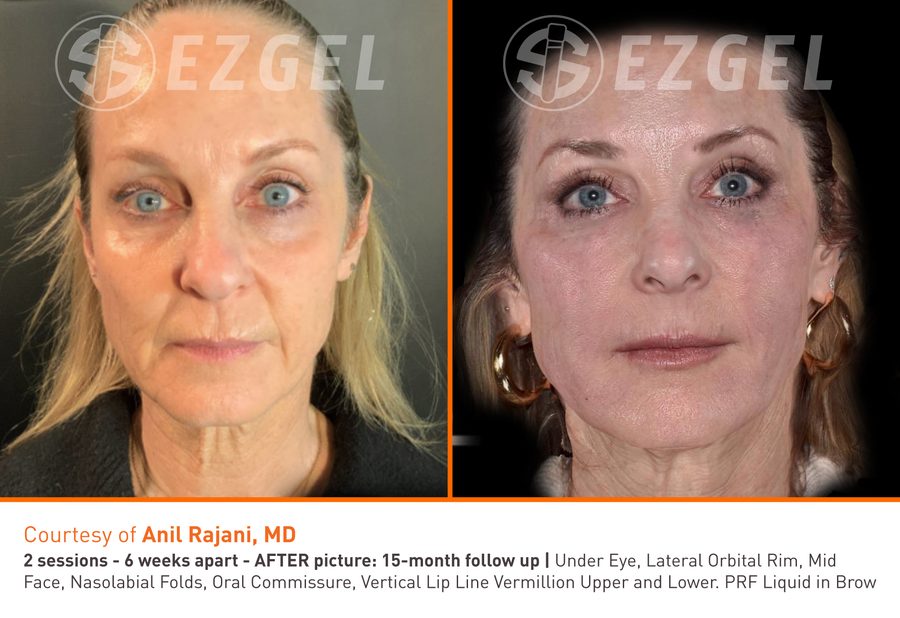 ezGEL Before and After 2 Results from ezGEL